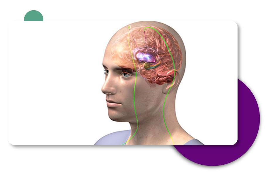 Deep brain Stimulation Treatment in Gurgaon, Delhi - India