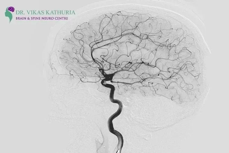Cerebral Angiogram for Brain Aneurysm