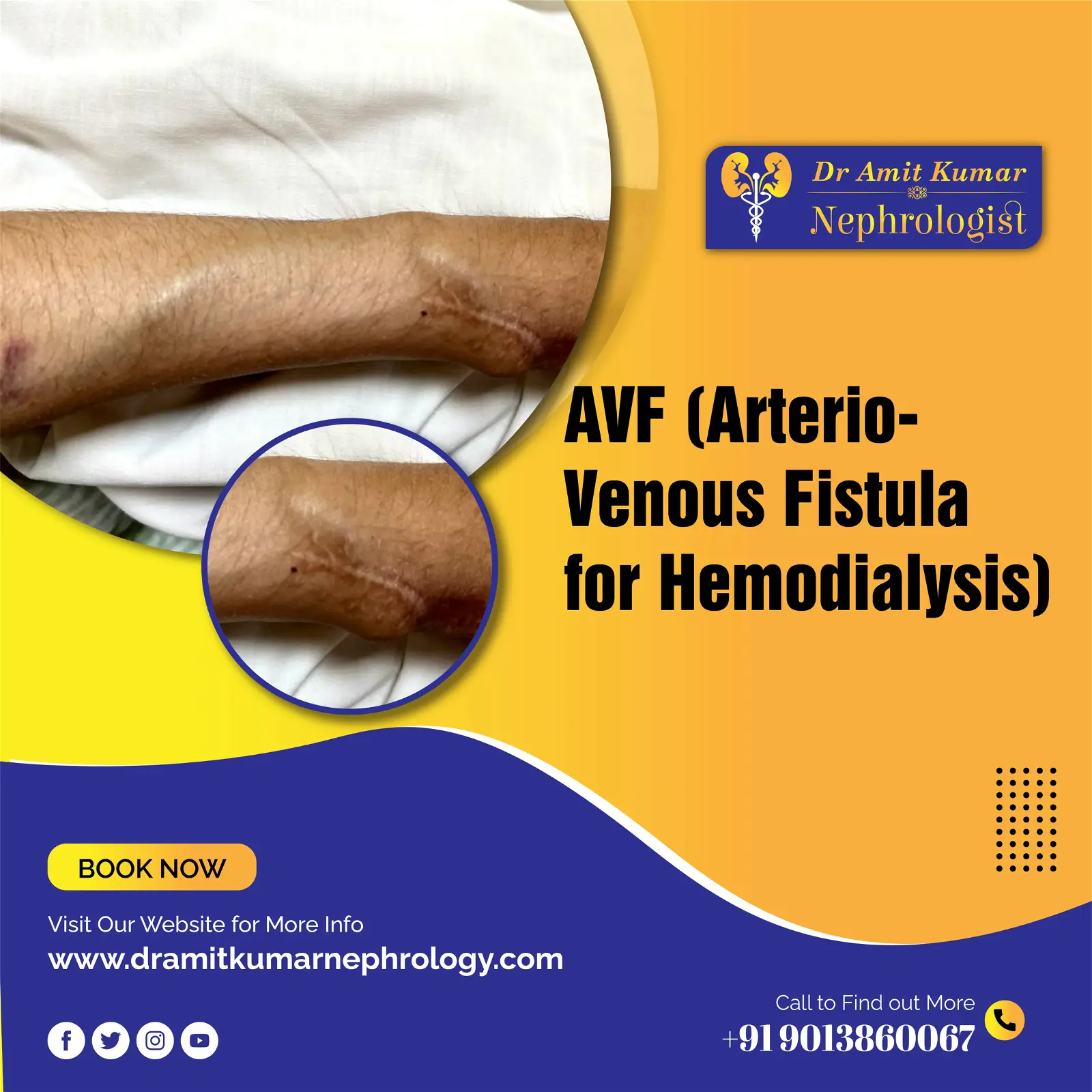 Arteriovenous fistula for Hemodialysis