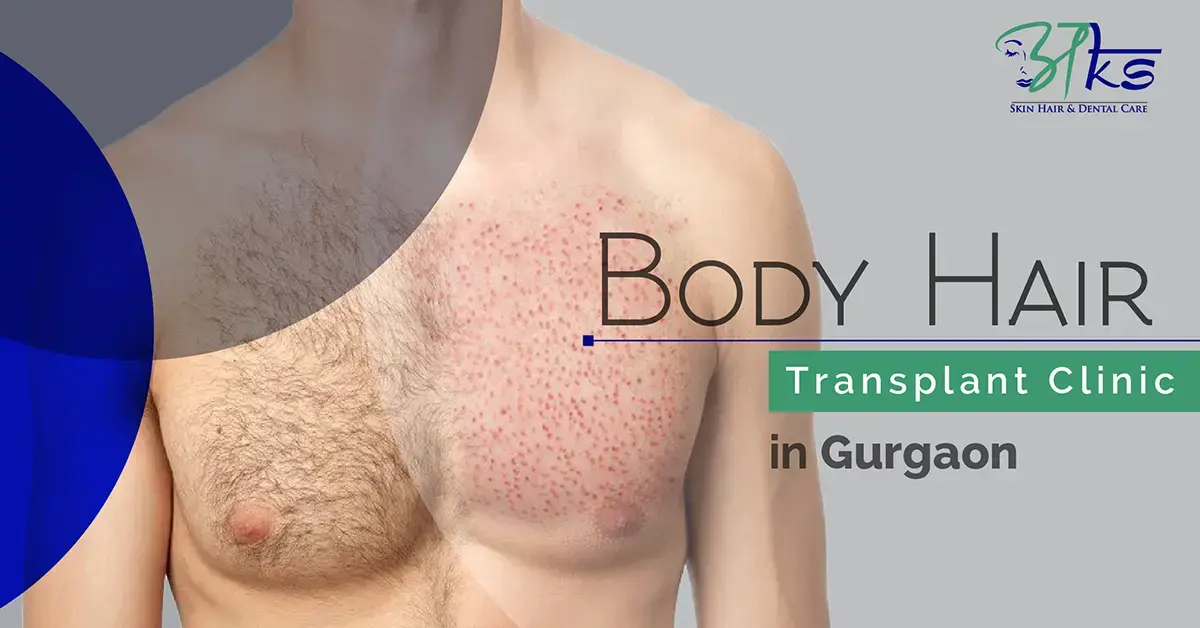 Body hair transplant Clinic in Gurgaon