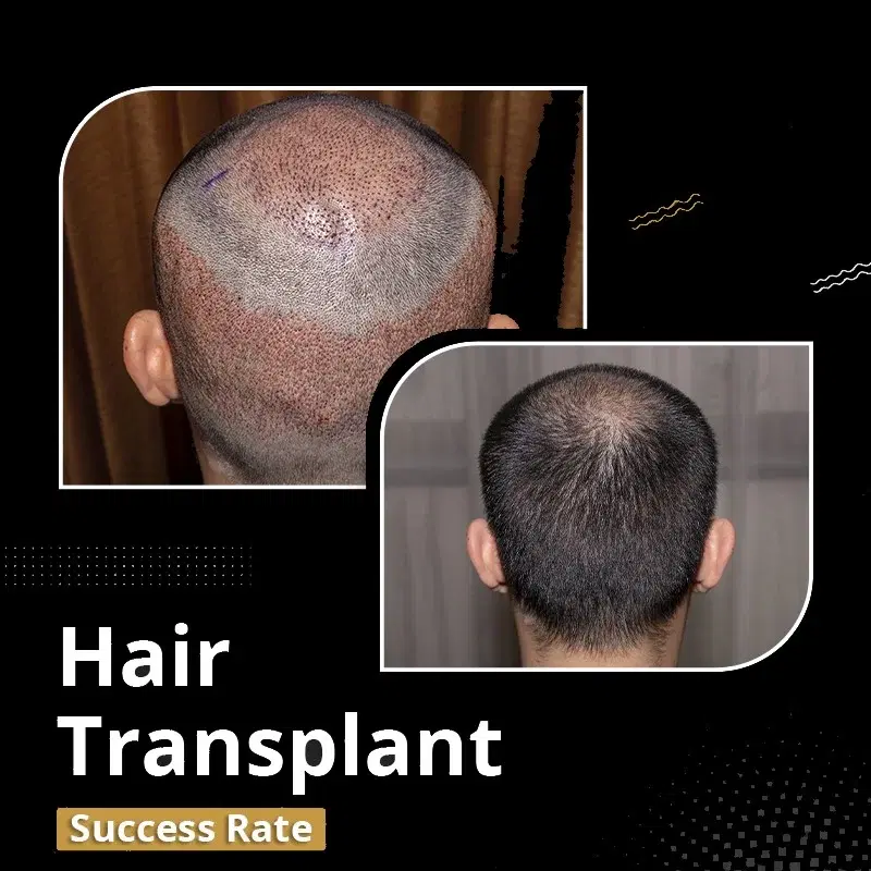 Do hair transplants really Successful