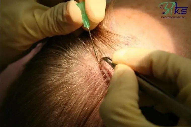 What is the most advanced hair transplant
