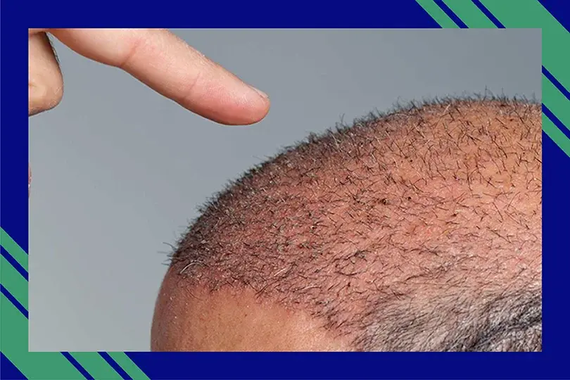 DHI THE TRUSTED AND BEST HAIR TRANSPLANT IN INDIA  Hair transplant in  india Best hair transplant Fue hair transplant