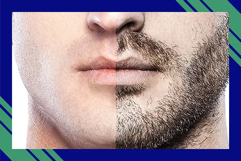 Best Mustaches and Beard Hair Transplant in Gurgaon Delhi NCR